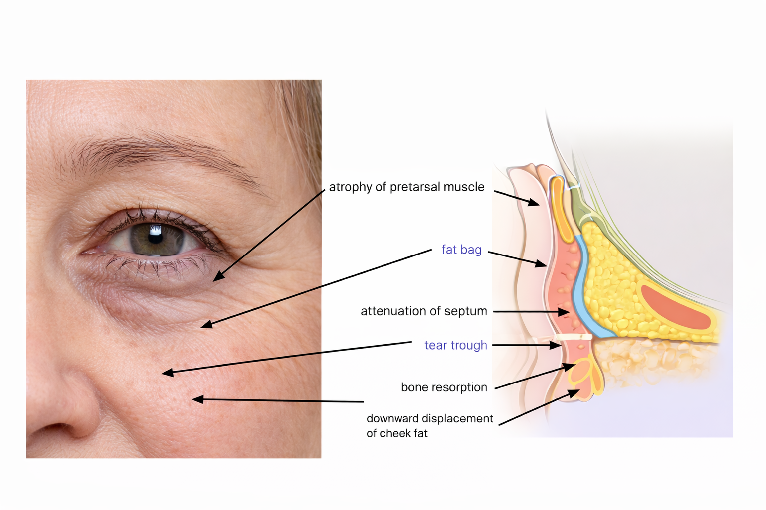 Before and after results using Eye Patches for dark circles and fine lines