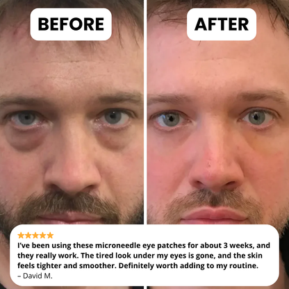 Novelia - Microneedle Patches