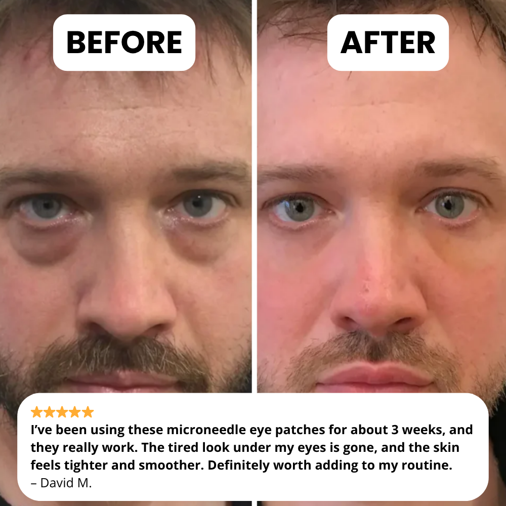 Novelia - Microneedle Patches